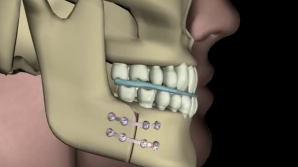 جهاز لإعادة بناء عظام الفك السفلى بالنقل القطعي