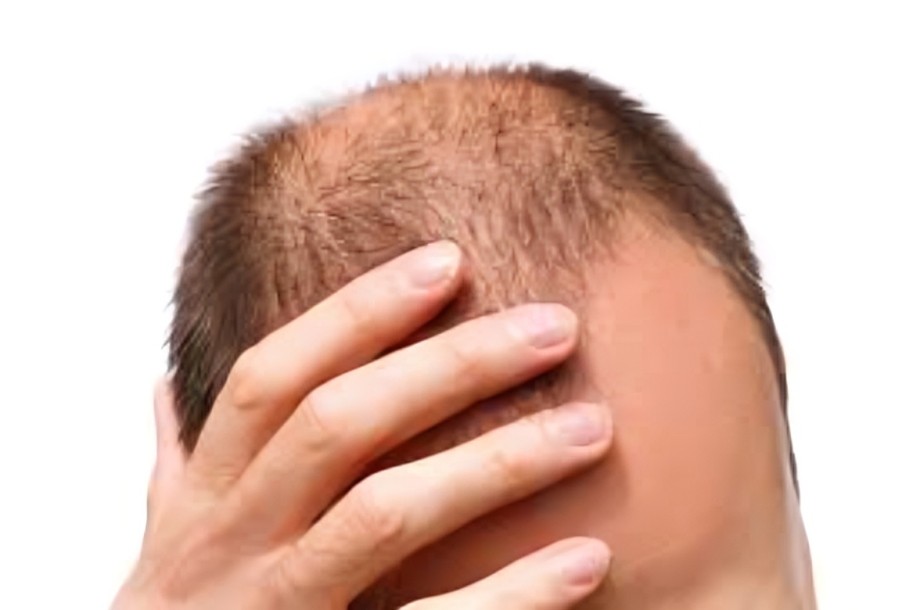 الحل السحري لمشكلة تساقط الشعر