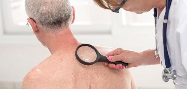 تشخيص وعلاج سرطان الجلد
