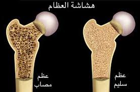 اختبار الدم يشخص هشاشة العظام قبل ثماني سنوات من ظهور الأعراض